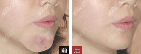 下巴奥美定取出修复案例