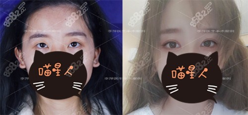 友谊医院李萍医生双眼皮<span style=