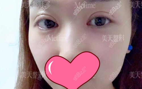 贝塞尔双眼皮术后1个月