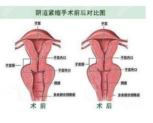 缩阴手术术前术后对比图