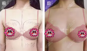 才杰隆胸怎么样？曼托假体隆胸案例参考