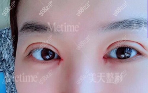 双眼皮手术拆线后