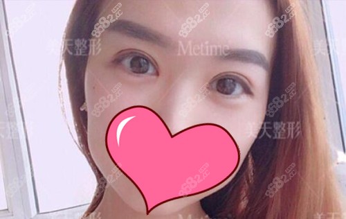 贝塞尔双眼皮手术后半年