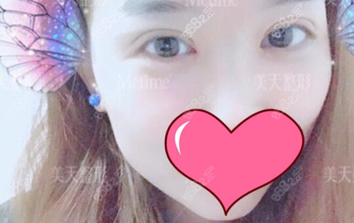 贝塞尔双眼皮手术后3个月