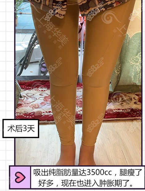 <!--<i data=20240705-sp></i>-->何斌吸脂