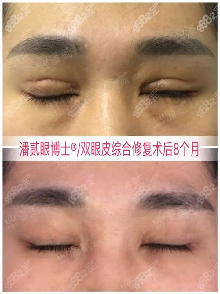 术前闭眼肉条感明显，痕迹重，做过双眼皮修复术后8个月