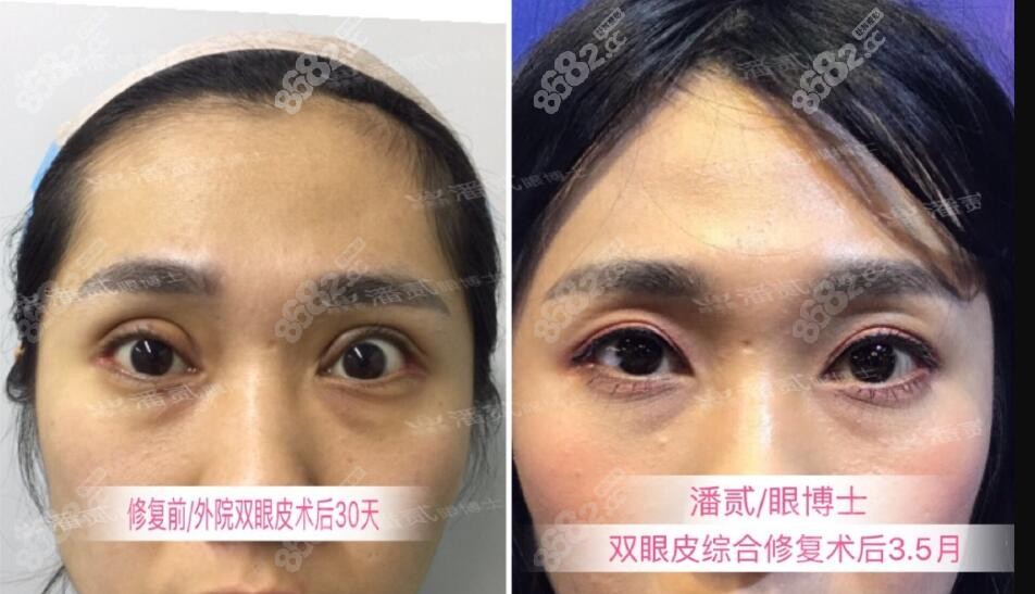 三次双眼皮不满意找到潘贰医生做修复