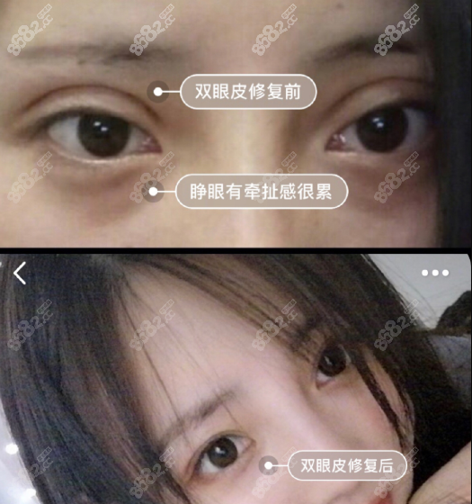 双眼皮修复前睁眼有拉扯感很累，做完修复手术之后眼睛很自然