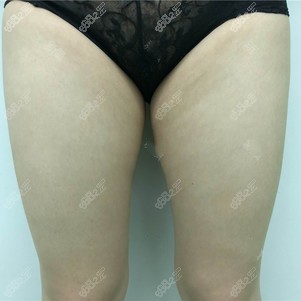 大腿吸脂前照片