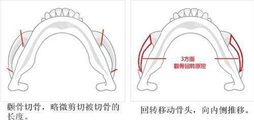 颧骨内推手术