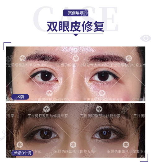 北京<!--<i data=20240705-sp></i>-->双眼皮修复案例