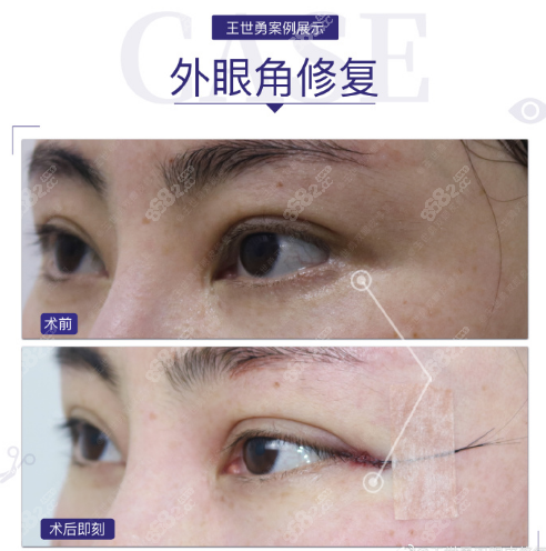 北京<!--<i data=20240705-sp></i>-->外眼角豁口修复案例