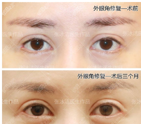 北京张冰洁外眼角修复案例
