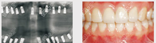 北京中诺口腔全口种植牙案例