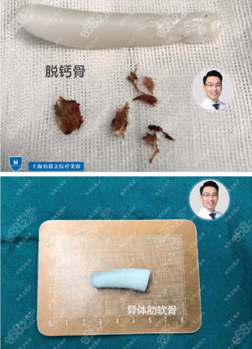 取出的脱钙骨