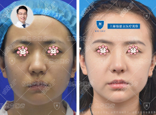 顾清缩鼻头案例