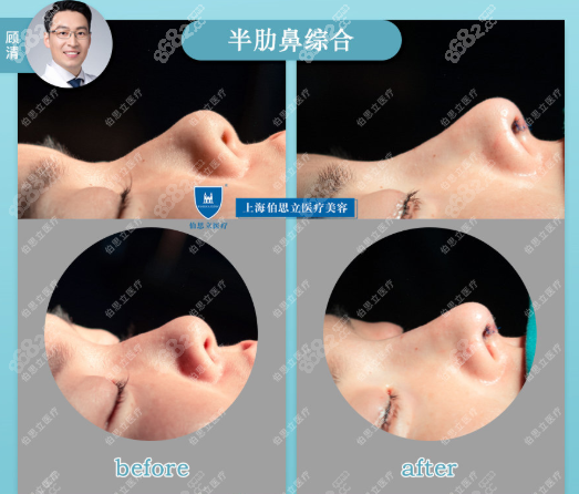 上海顾清医生半肋鼻综合案例