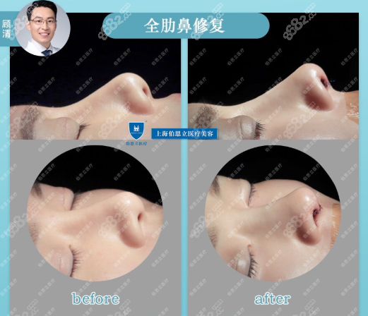 顾清全肋鼻修复案例