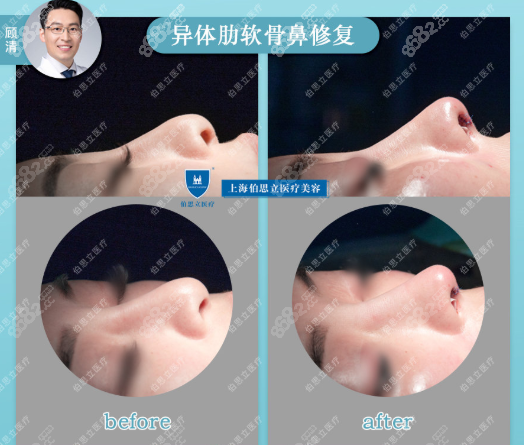 异体骨鼻修复案例