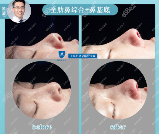 顾清全肋鼻综合案例