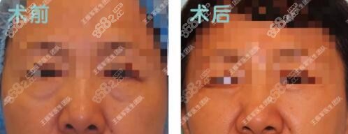 <!--<i data=20240705-sp></i>-->CFSP祛眼袋真人前后对比照