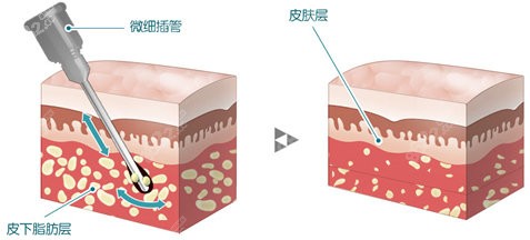 自体脂肪填充过量怎样办?