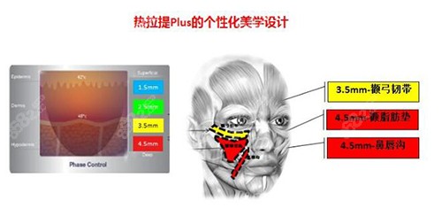 热拉提plus的治疗深度