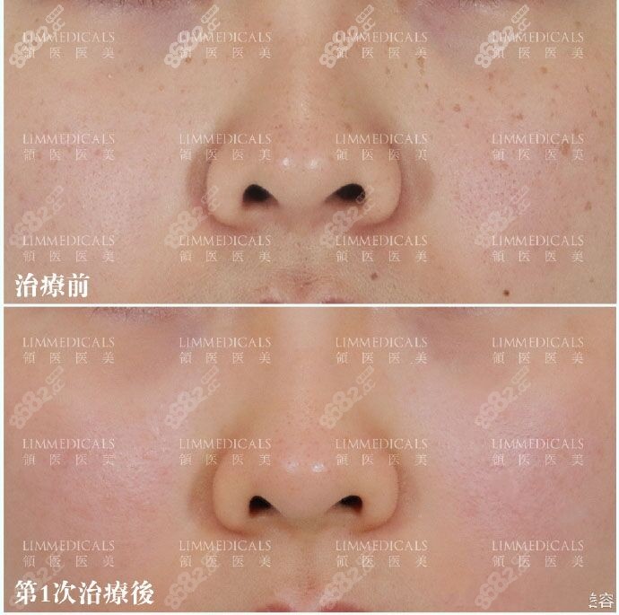 北京领医医疗美容皮秒祛斑效果案例