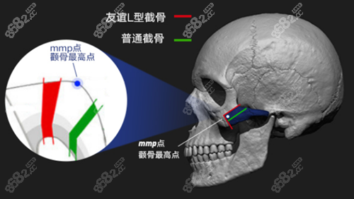 四川友谊医院截骨方式