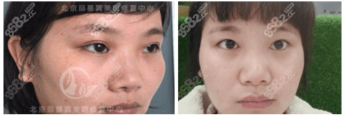 北京魏志香全切双眼皮改单眼皮手术案例