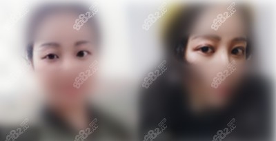 <!--<i data=20240705-sp></i>-->华美美容医院双眼皮<span style=
