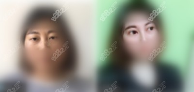 <!--<i data=20240705-sp></i>-->华美美容医院双眼皮<span style=