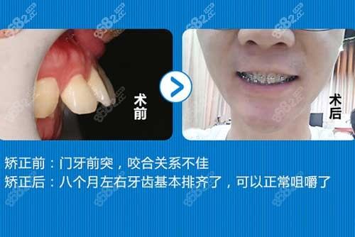 广州穗华口腔医院牙齿矫正图