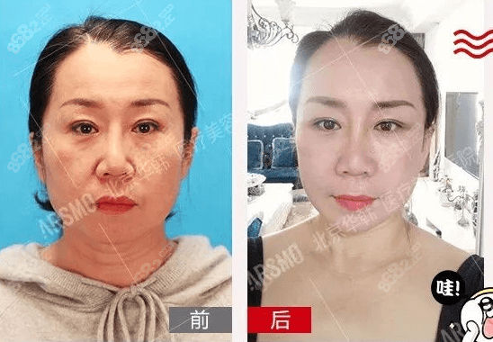 北京华韩柳民熙3D童颜提升术案例