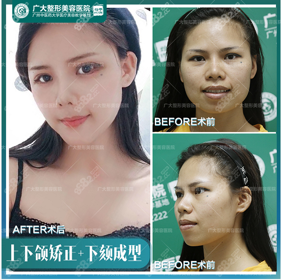 上下頜+下頦成型案例對比 上下頜+下頦成型案例對比