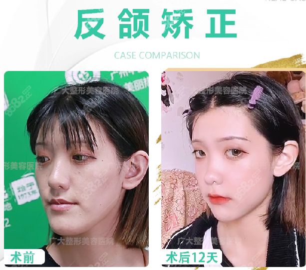 反頜矯正前后案例對比 反頜矯正前后案例對比