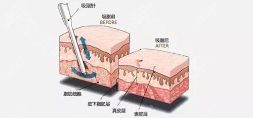 分层吸脂的操作原理