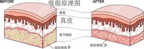 吸脂分层和立体的区别