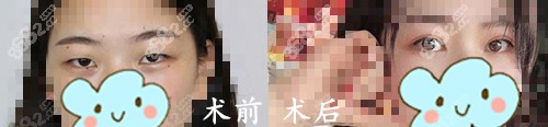 长沙亚韩整形美容医院双眼皮手术案例