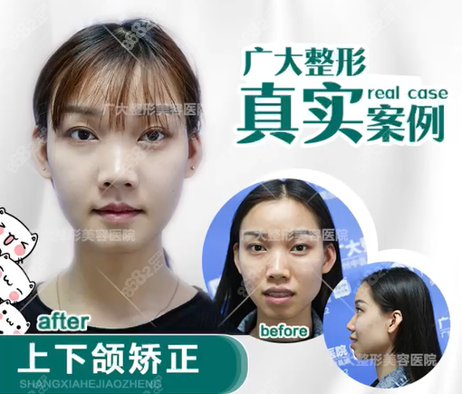 地包天做上下頜矯正前后對比 地包天做上下頜矯正前后對比