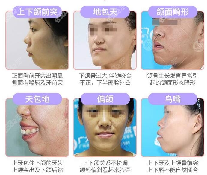 正頜手術(shù)主要針對改善的癥狀 正頜手術(shù)主要針對改善的癥狀