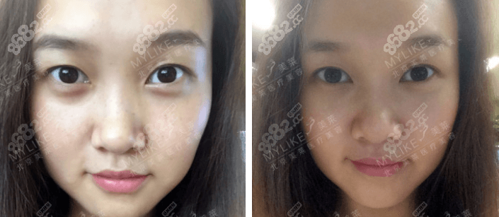 北京美萊皮秒祛斑好不好？真人案例參考