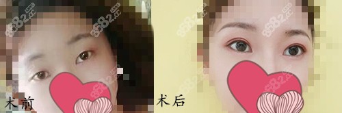 长沙艺星整形美容医院眼综合手术案例