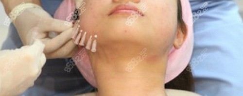 埋入4S螺旋線后的效果