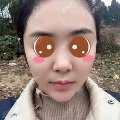 做面部埋線提升一個(gè)月后的效果