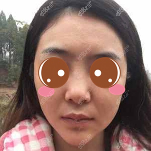 全臉埋線提升后會有腫脹期