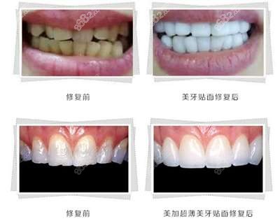 牙元素口腔门诊牙贴面效果