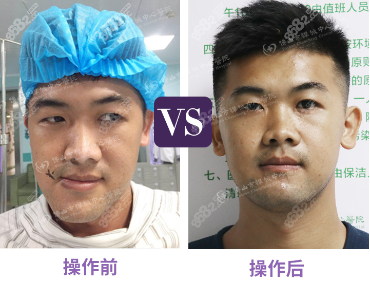 面部不对称做正颌手术前后案例