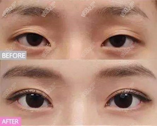 乌市华美整形医院眼整形