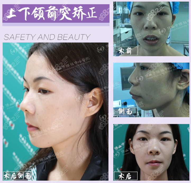 上下颌前突矫正，前后治疗方案